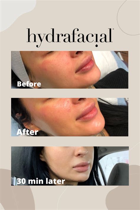 How To Take Care of Your Skin After A Hydrafacial .